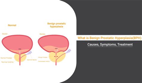 Benign Prostatic Hyperplasia (BPH): Causes, Symptoms, And, 51% OFF