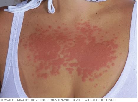 Polymorphous light eruption - Symptoms and causes - Mayo Clinic