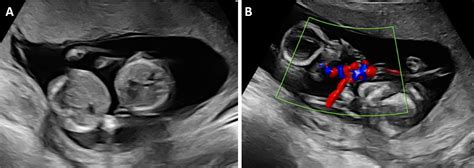 Monochorionic monoamniotic twin pregnancies - American Journal of Obstetrics & Gynecology MFM