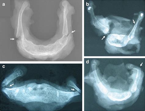 X-ray views of hyoid bone with fractures after fatal trauma on the... | Download Scientific Diagram