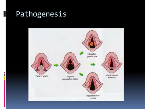 PPT - Laryngeal complications of endotracheal intubation PowerPoint ...