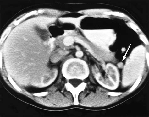 CT Features of the Accessory Spleen | AJR