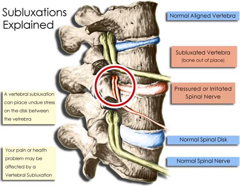 Subluxations Explained in Austin