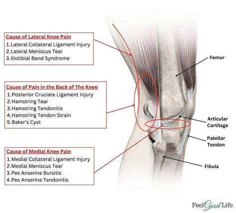 Types Of Knee Pain: Anterior, Posterior, Medial, Lateral, 52% OFF