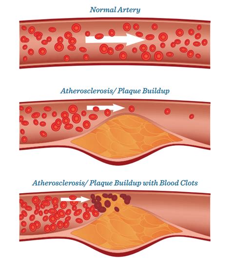 Atherosclerosis | Men's Health Resource Center