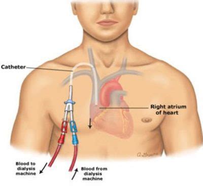 Permcath or Tunneled Catheter Insertion | Varicose veins | Vascular ...