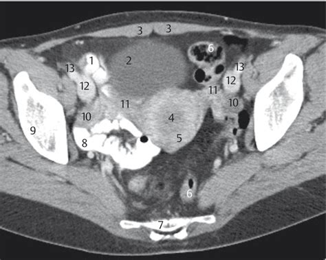 Female Pelvis | Radiology Key