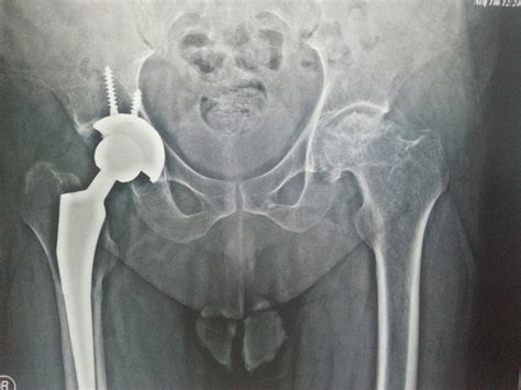 Neck of femur fracture surgery - wikidoc