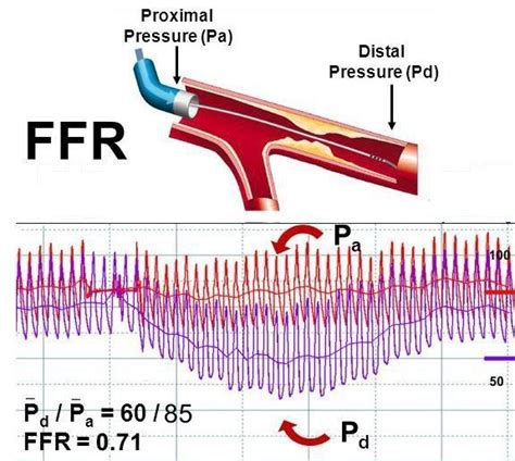 What Are The Benefits Of Using FFR In Angiograms? — Medipulse: Best ...