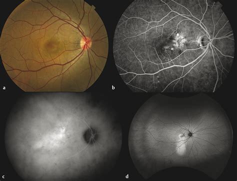 Central Serous Chorioretinopathy and Pachychoroid Disease | Ento Key