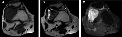 Giant cell tumor of bone appearance on magnetic resonance imaging... | Download Scientific Diagram