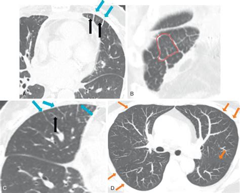 Normal Anatomy of the Lungs | Radiology Key