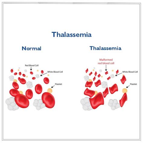 World thalassemia day celebrating progress in treatment and raising awareness for a better future