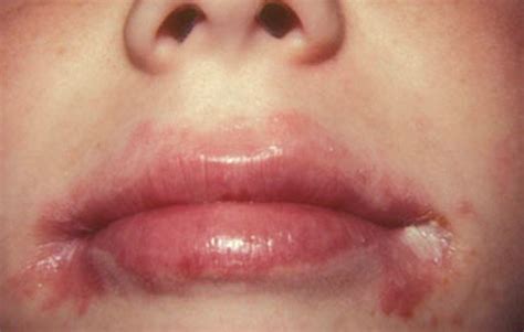 12 Natural Treatments for Angular Cheilitis