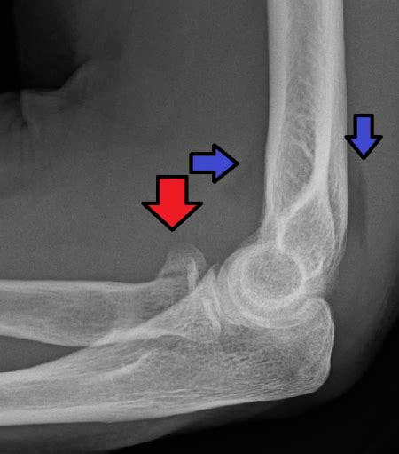 Radial head fracture (peds) - WikEM