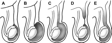 Pediatric Inguinal Hernias, Hydroceles, and Undescended Testicles - Surgical Clinics