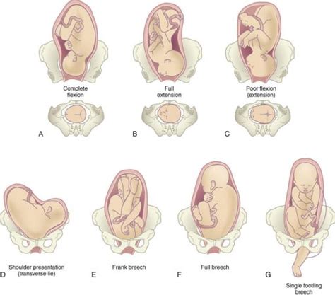 Transverse baby | BabyCenter