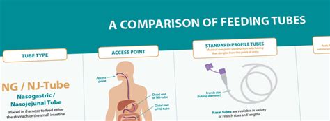 Comparison of Different Enteral Feeding Tubes and Configurations - Moog Medical