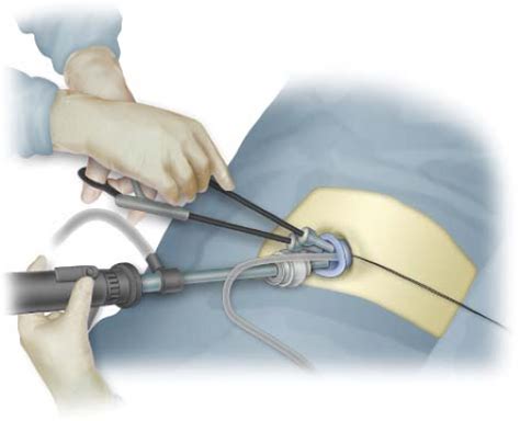 Single Incision Laparoscopic Surgery: Total Extraperitoneal Inguinal Hernia Repair | Abdominal Key