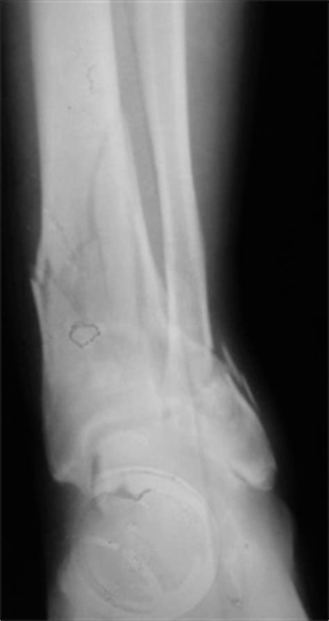 Tibial Plafond Fractures - Trauma - Orthobullets