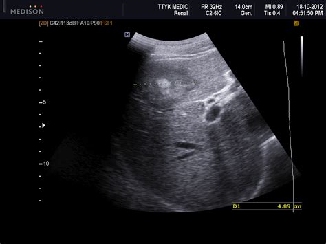 Liver Cancer: Liver Cancer Ultrasound Scan