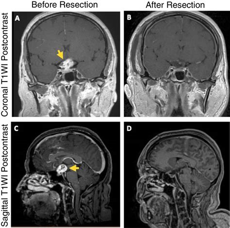 MRI images of craniopharyngioma before and after resection. Coronal... | Download Scientific Diagram