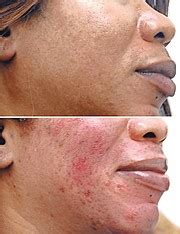 The dangers of skin bleaching | The Tribune