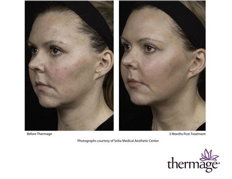 Thermage Skin Tightening | Radiance MedSpa Wheaton