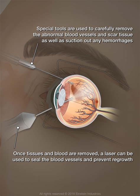 Diabetic Retinopathy Surgery