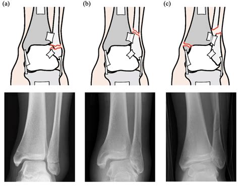 The Danis–Weber classification system. Right foot viewed posteriorly:... | Download Scientific ...