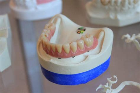 What Do You Know About Dental Veneers, And What Are Their Types? - Blogs - WebDental, LLC