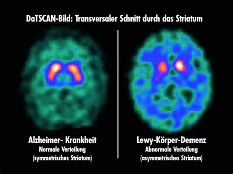 quattro Sentirsi male Meno datscan lewy body dementia amoroso ...