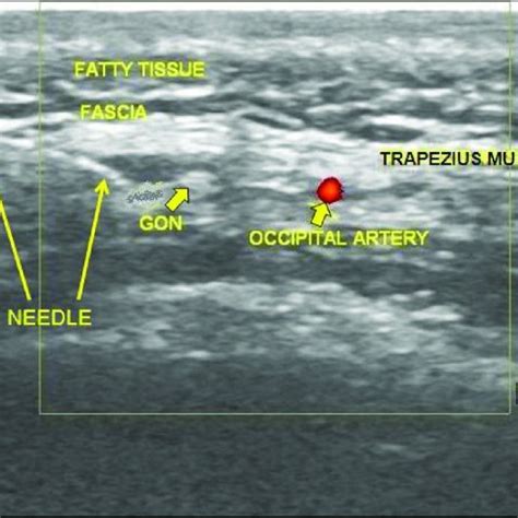 Patient 1; Ultrasound Image of the Greater Occipital Nerve in Relation... | Download Scientific ...