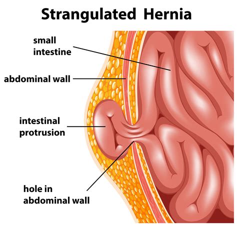 Hernia Estrangulada 296919 Vector en Vecteezy