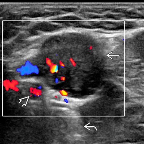 Nerve Sheath Tumors | Radiology Key