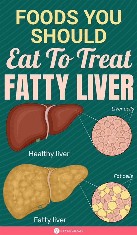 Fatty Liver Diet, Foods To Cleanse Liver, Foods For Liver Health, Liver Detox Diet, Healthy ...