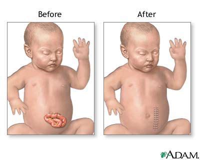 gastroschisis | Neonatology, Maternity nursing, Aftercare