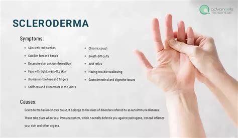 Scleroderma Symptoms, Causes, Types, Diagnosis & Treatment
