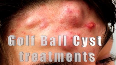 How to treat huge acne cysts the size of golf balls! - YouTube