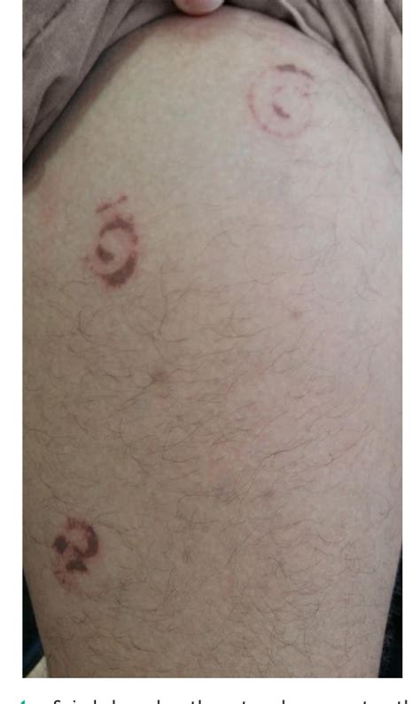 Figure 1 from Millipede accident with unusual dermatological lesion☆☆☆ | Semantic Scholar