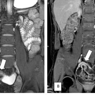 Enteroenteric fistula in a 40 years old patient known CD presented with... | Download Scientific ...