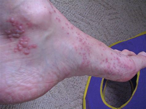 shingles on foot | Flickr - Photo Sharing!