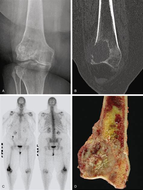 Metastatic Tumors in Bone | Basicmedical Key