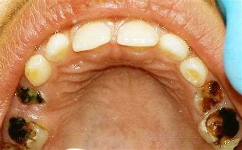 How to eliminate pain tied to tooth decay | health.am