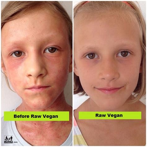 Raw Food Skin Before And After Transformation (With Photos)