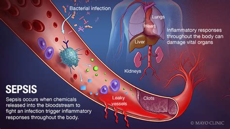 Mayo Clinic Q and A: Understanding sepsis and septic shock - Mayo ...