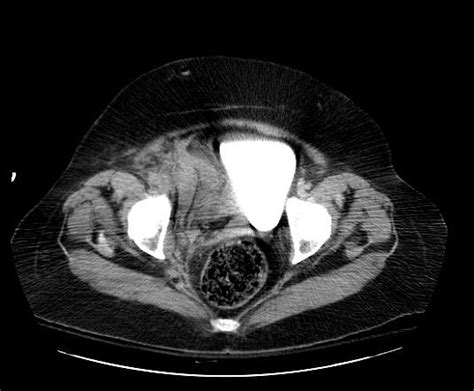 Retroperitoneal hematoma - wikidoc