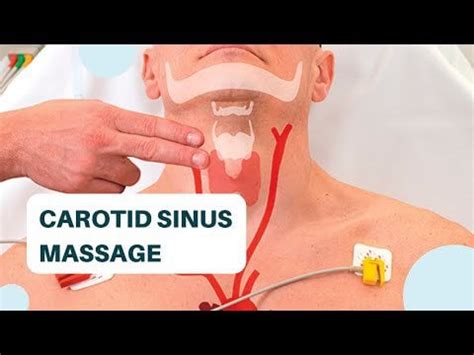 Carotid Sinus Massage: What is it and How to perform the procedure? : r/doctors