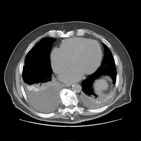 Aspiration pneumonia bacterial infection ct scan - wikidoc