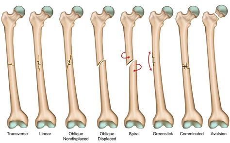 Distal Femur Fracture Classification